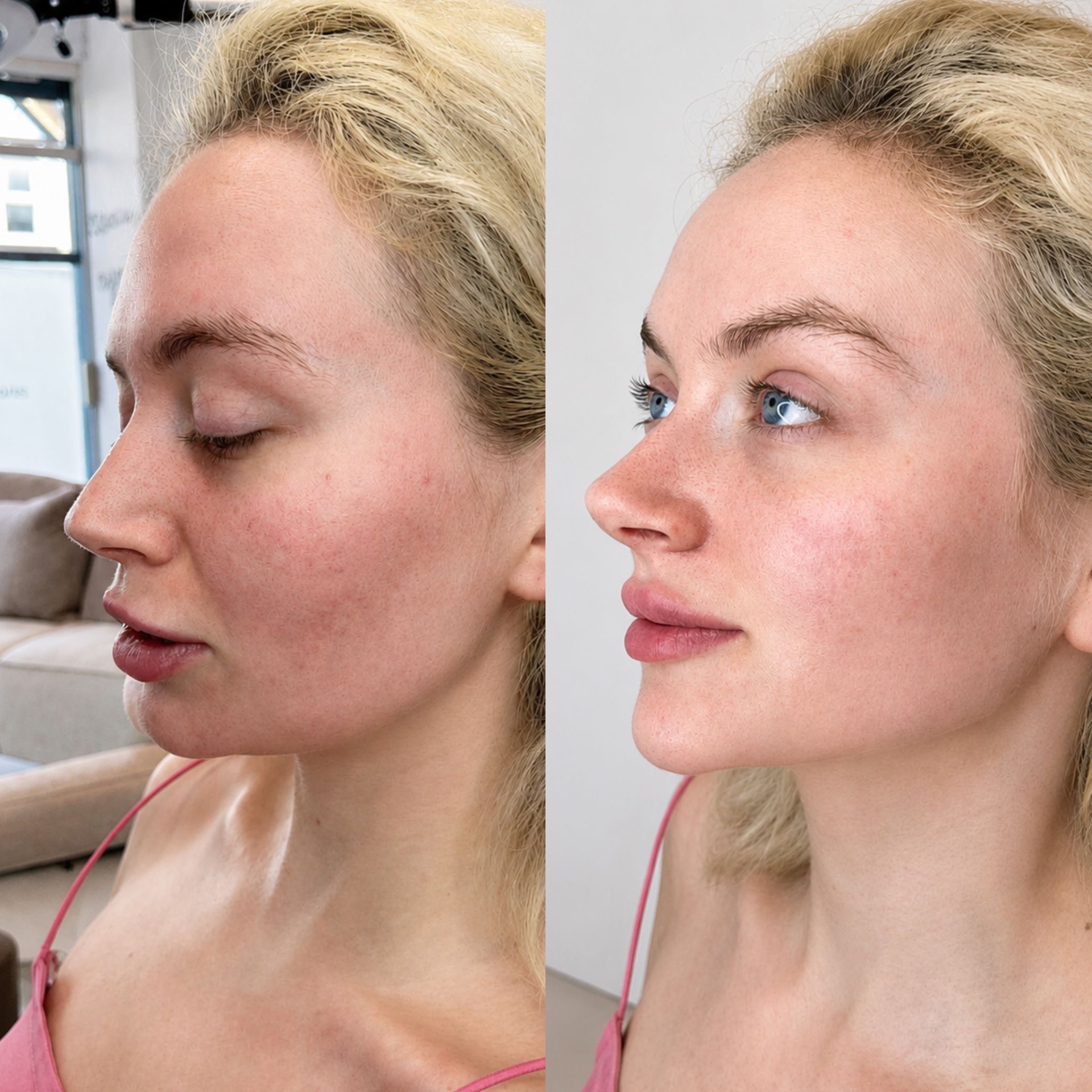 Facial Balancing before and after at The Natural Sculpt, London