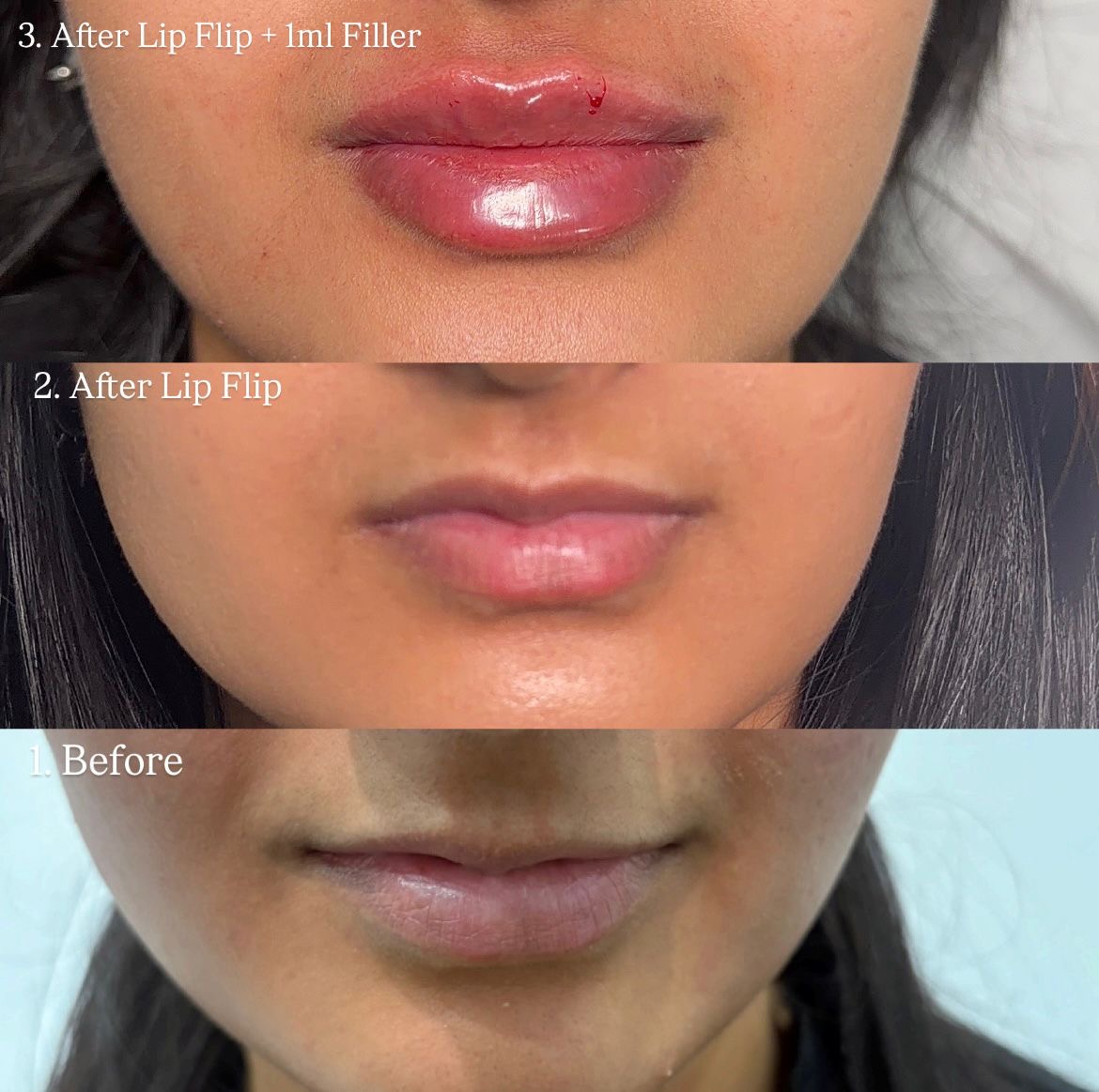 Lip Flip & Filler before and after at The Natural Sculpt, London