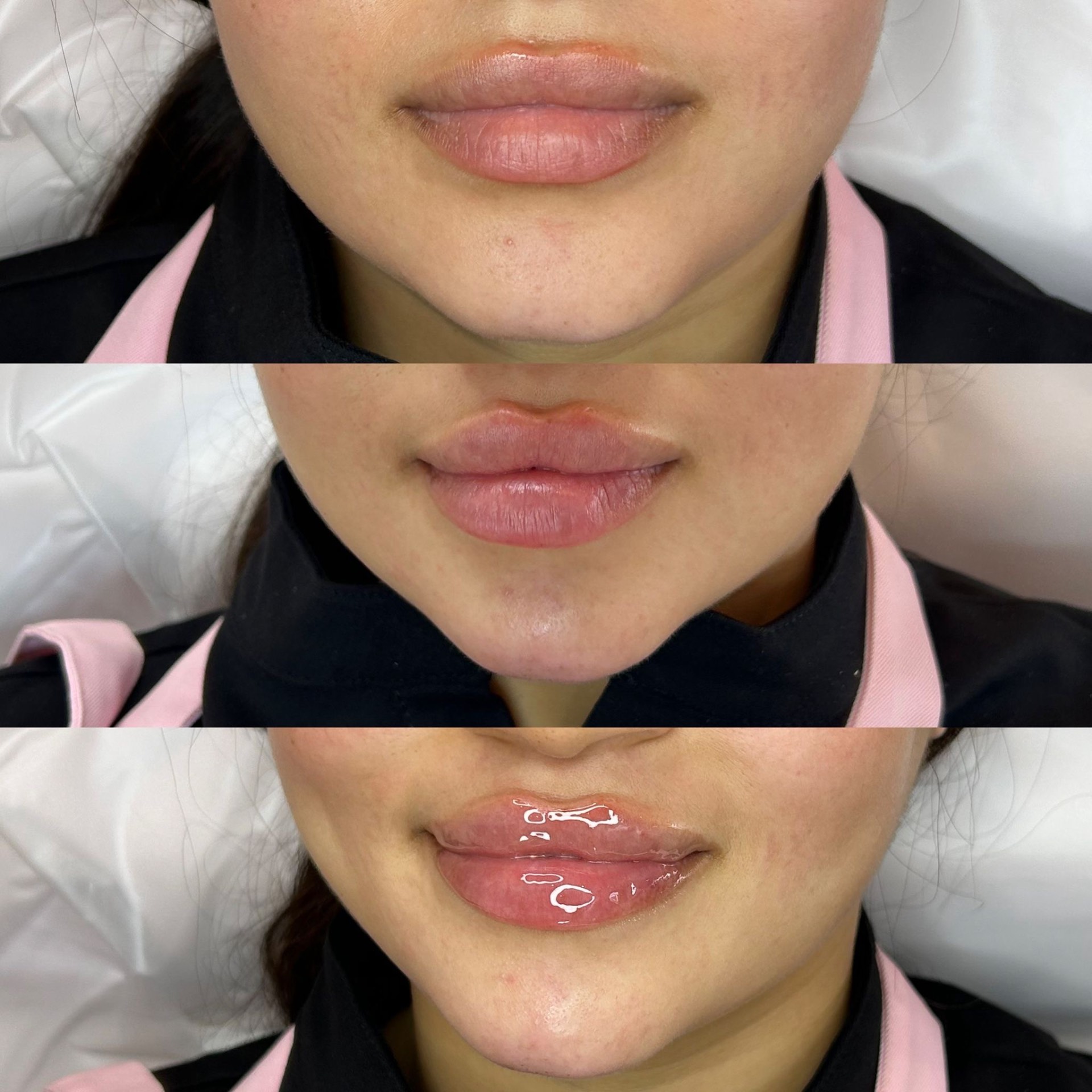 Lip Enhancement before and after at The Natural Sculpt, London