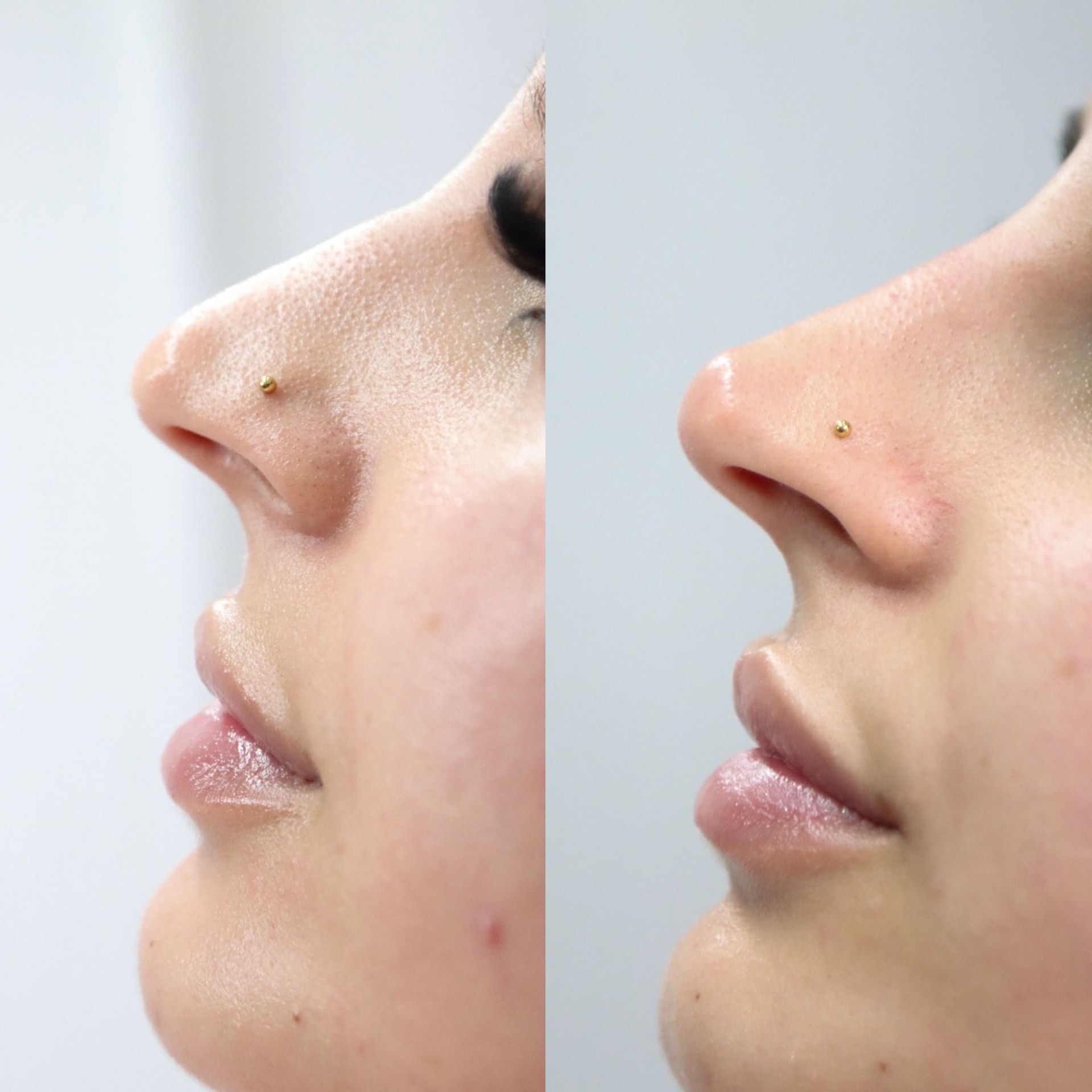 Non-Surgical Nose Refinement before and after at The Natural Sculpt, London