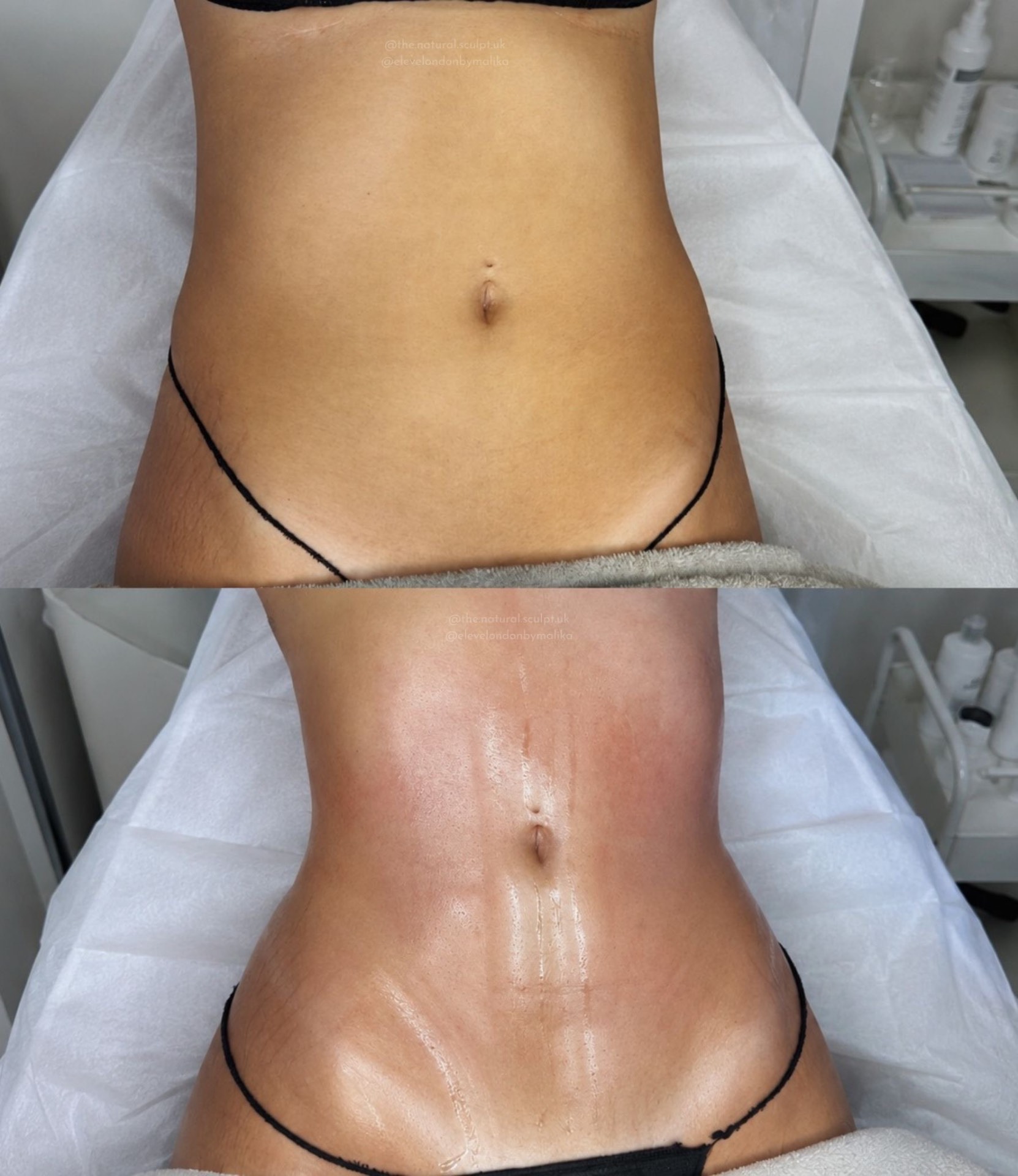 Before and after body sculpting at The Natural Sculpt, London