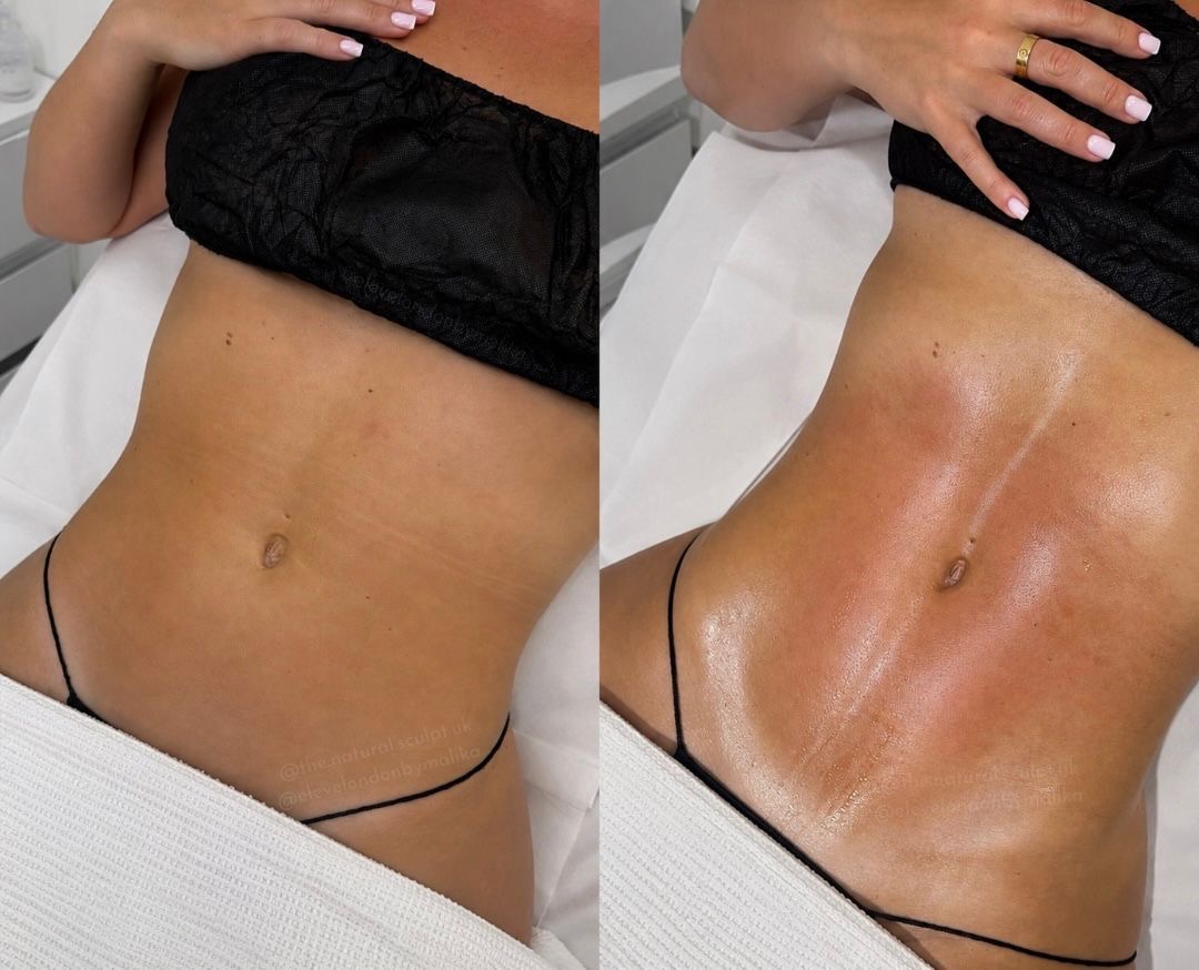 Before and after body sculpting at The Natural Sculpt, London